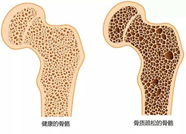 骨質疏松癥分為局限型和彌漫型